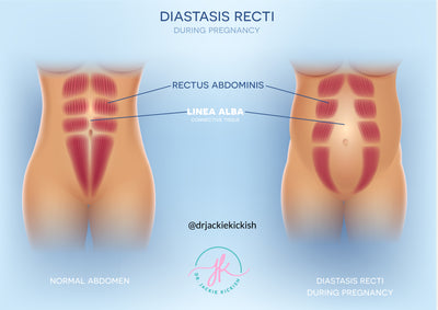 Diastasis Recti 101